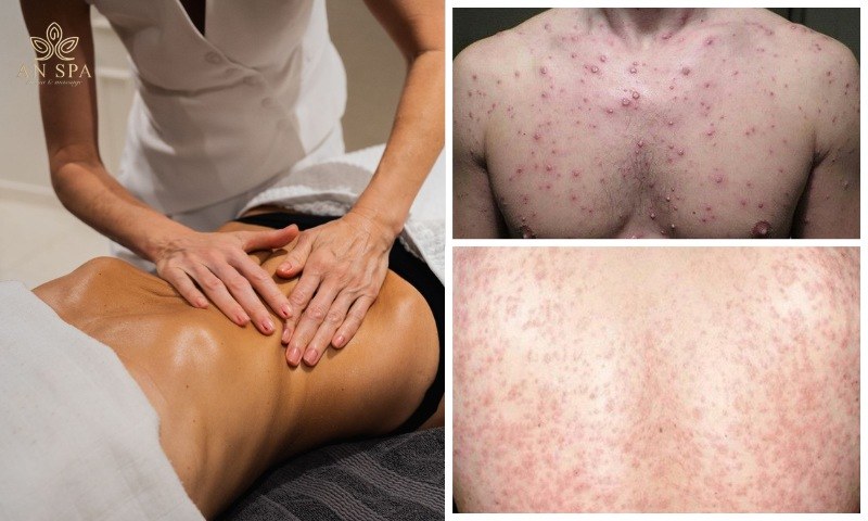 các vấn đề da liễu trong môi trường massage kém vệ sinh